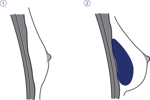 Brustimplantat über dem Muskel
