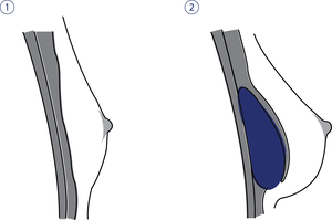 Brustimplantat unter dem Muskel