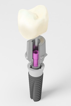 Aufbau Zahnimplantat mit Krone
