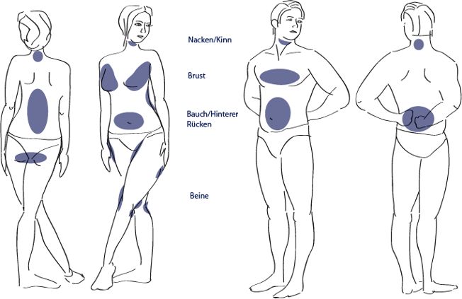 Illustration Fettabsaugung Problemzonen Mann Frau