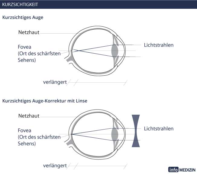 Sehrschwächen: Kurzsichtigkeit Auge Korrektur