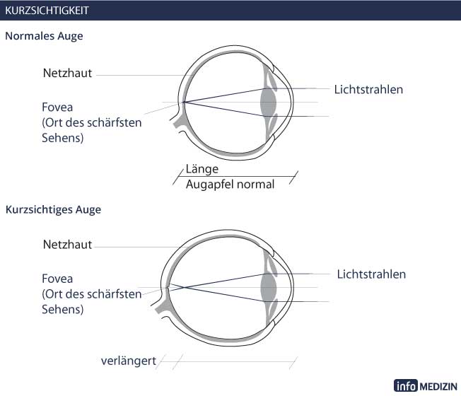 Sehrschwächen: Kurzsichtigkeit Auge