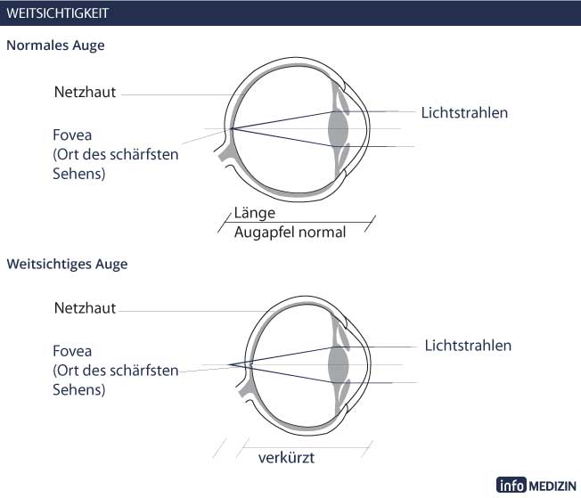 Sehrschwächen: Weitsichtigkeit Auge