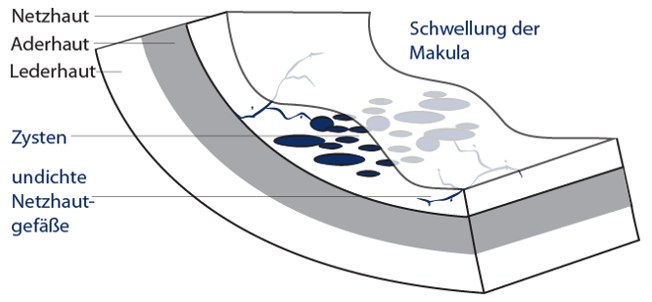 Diabetisches Makulaödem im Detail