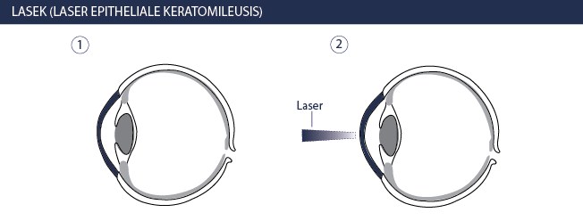 Augenlasern LASEK