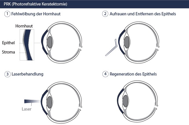 Augenlasern PRK