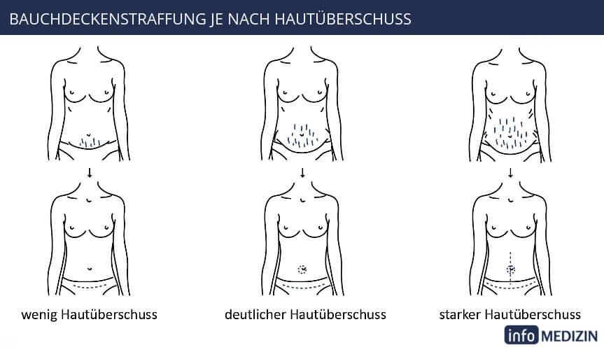 Bauchdeckenstraffung Frau