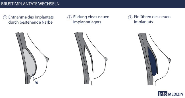 Brustimplantate wechseln