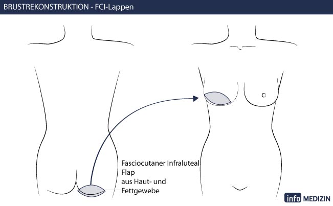 Brustrekonstruktion Eigengewebe Technik FCI Lappen