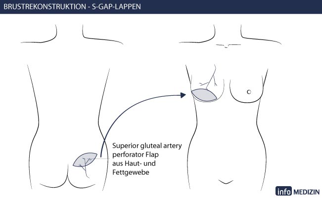 Brustrekonstruktion Eigengewebe Technik S-GAP