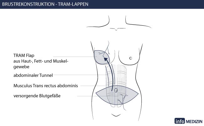 Brustrekonstruktion Eigengewebe Technik TRAM