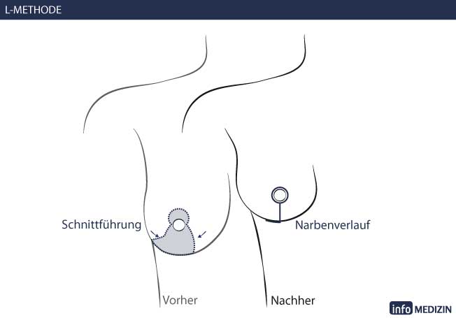 Brustverkleinerung L Methode