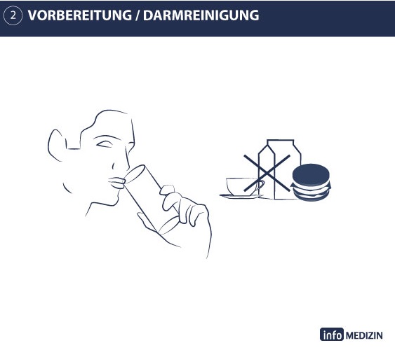 Illustration Darmspiegelung Ablauf Darmreinigung