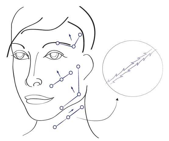 Fadenlifting Illustration