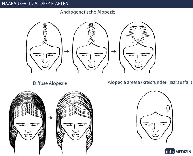 Haarausfall Arten im Vergleich