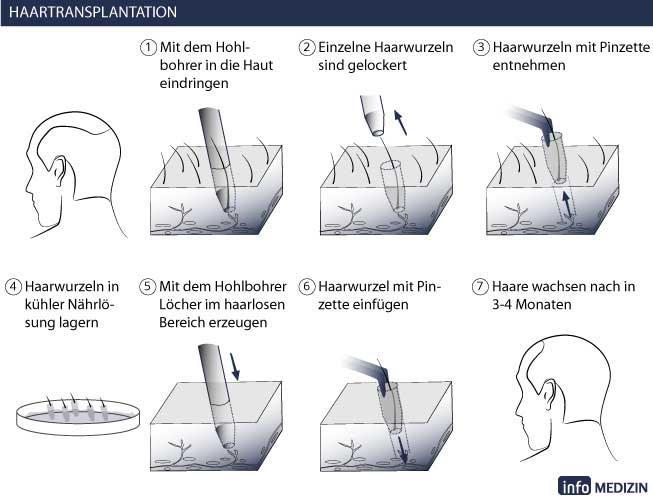 haartransplantation ablauf