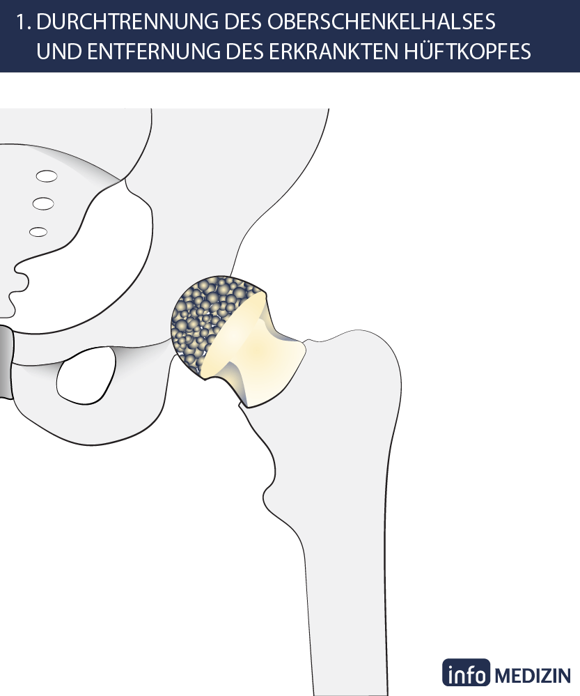 Hüft-OP Schritt 1