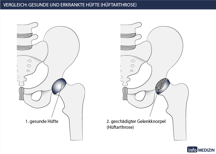 Vergleich gesunde und erkrankte Hüfte Hüftarthrose