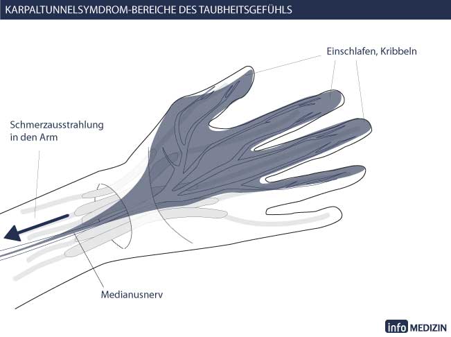 Karpaltunnelsyndrom Taubheitsgefühl