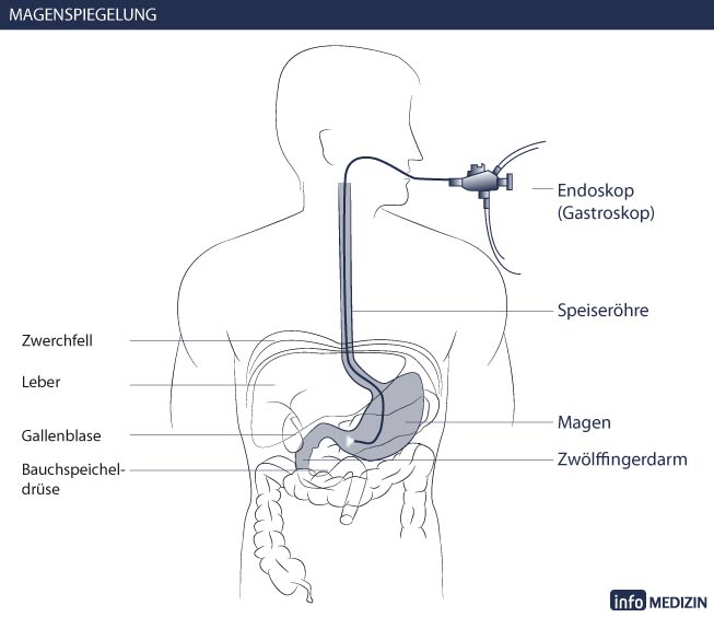 Magenspiegelung