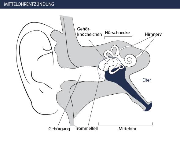 Mittelohrentzündung