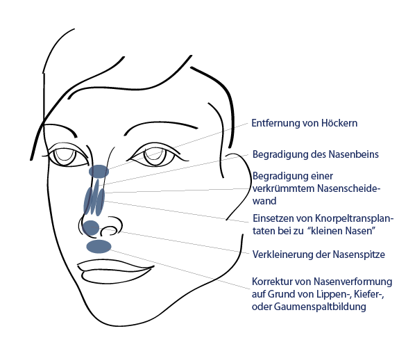 Nasenkorrektur Behandlungsbereiche