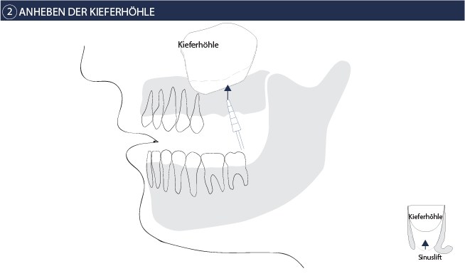 Sinuslift Schritt 2