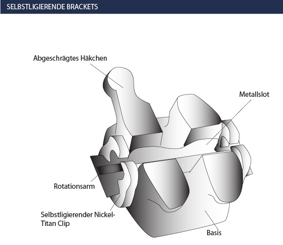 Selbstligierende Brackets