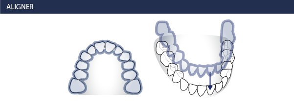 Zahnspange Invisalign