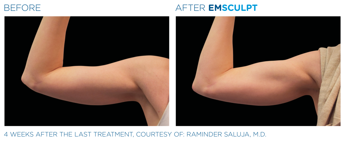 EMSCULPT® NEO Vorher Nachher Arme