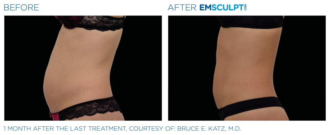 EMSCULPT® NEO Vorher Nachher Bauch