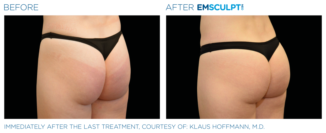 EMSCULPT® NEO Vorher Nachher Po