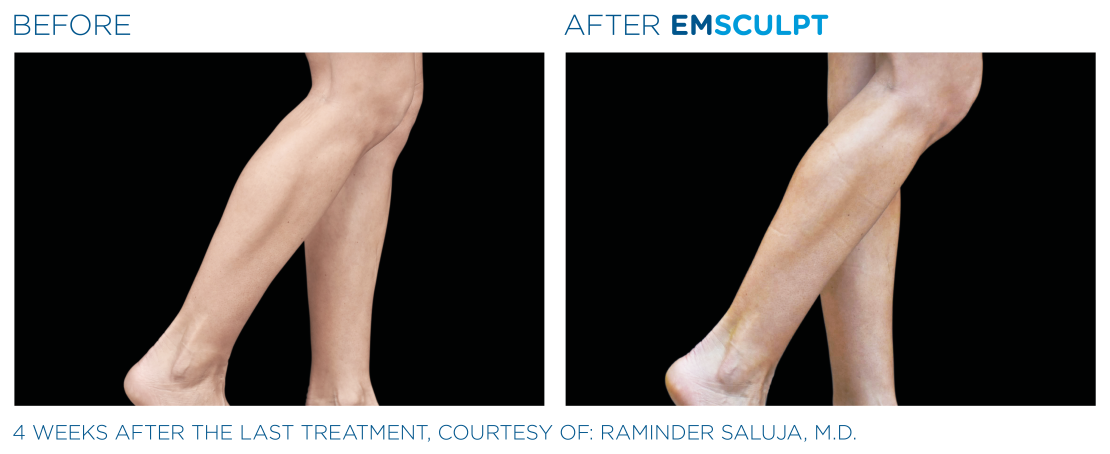 EMSCULPT® NEO Vorher Nachher Waden